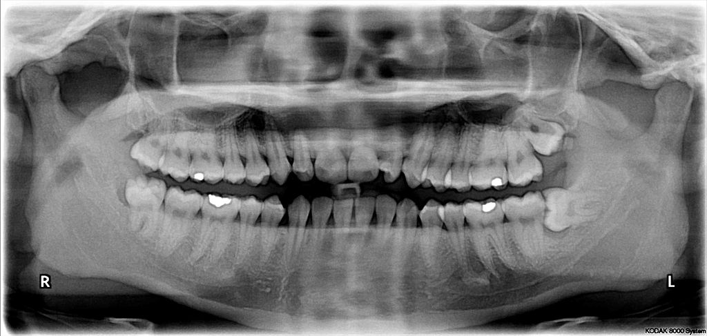 The upper left (picture right) and upper right (picture left) wisdom tooth are distoangularly impacted. The lower left wisdom tooth is horizontally impacted. The lower right wisdom tooth is vertically impacted (unidentifiable in X-ray image). The glowing parts in the teeth are cavities filled with amalgam. Credit: Ka-ho Chu Wikipedia, Under Public Domain